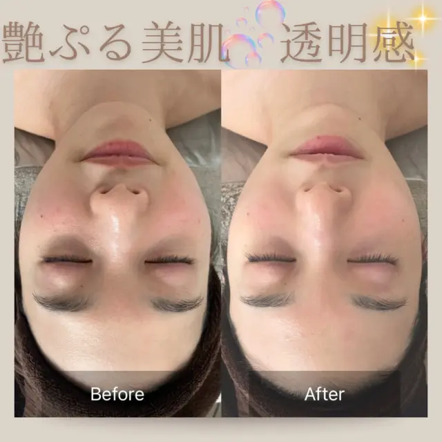 肌質改善エステサロン♡様あ専用 新潟｜毛穴肌質改善｜エステ｜サロンラクシュミー｜林秋奈